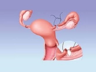 Service-Laparoscopic Tubal Ligation