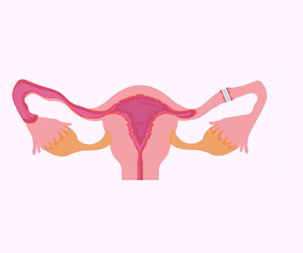 Laparoscopic Tubal Ligation in Nashik