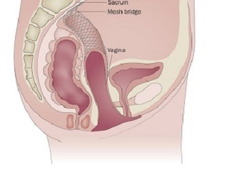 Service-Lap Prolapse Repair